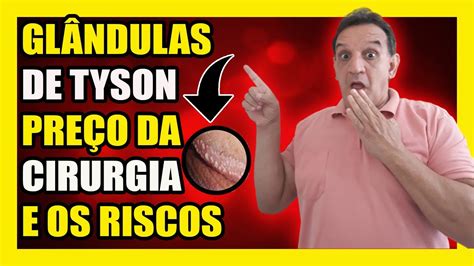 Glândulas de Tyson: o que são, porque aparecem e。